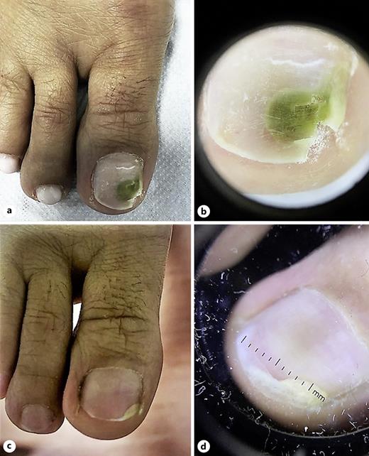 Green Nail Syndrome Treated with Ozenoxacin Two Case Reports Case