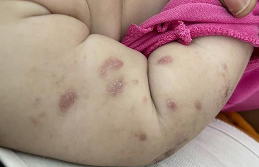 Erythematous and hyperpigmented papules and nodules, some with thick overlying scales, on the bilateral upper extremities.