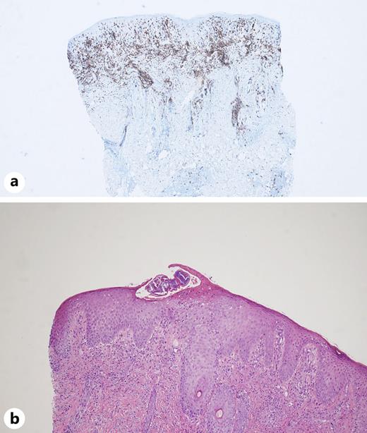 a CD1a positively staining infiltrate, extending to the deep dermis. b A burrow containing the edge of a mite in the stratum corneum.