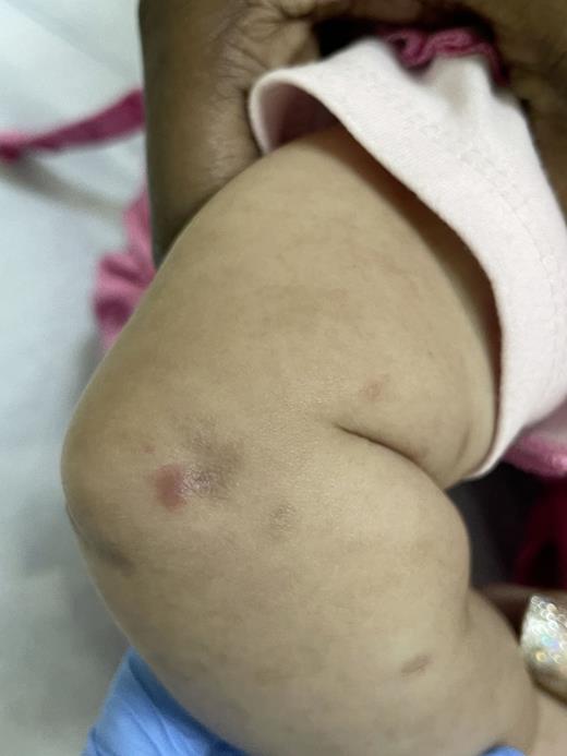 Firm pink nodules on the upper extremity after scabies treatment.
