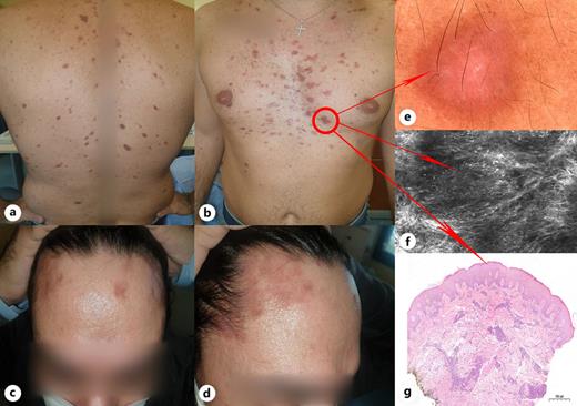 Multiple brownish papules on the back (a); multiple brownish papules on the chest (b); multiple brownish papules on the head/neck region (c); multiple brownish papules on the head/neck region, lateral view (d); dermoscopy of one lesion showed peripheral hyperpigmentation, with central pale amorphous brownish area, consistent with dermatofibroma-like pattern (e); RCM of one lesion showed increased vascularization of the papillary dermis along with extended fibrotic areas and scattered hyper-reflective cells, corresponding to dermal plasma cells. The general RCM features show a dermatofibroma-like pattern with inflammatory cells (f); cutaneous biopsy of one lesion showed dermal perivascular plasmocellular infiltrate, with mild remodeling of collagen bundles (Hematoxylin and eosin. ×100) (g).