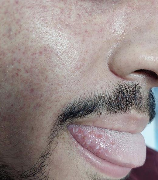 Eroded tongue secondary to biting during ictal episode.