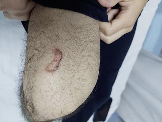 Well-demarcated eroded plaque over the distal thigh.