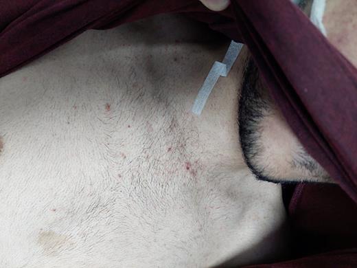 Petechial rash over the upper chest.