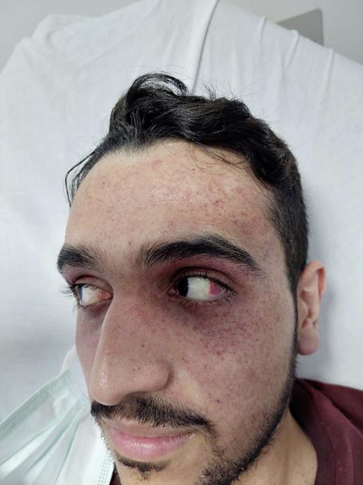 Periorbital purpuric rash and conjunctival hemorrhage.