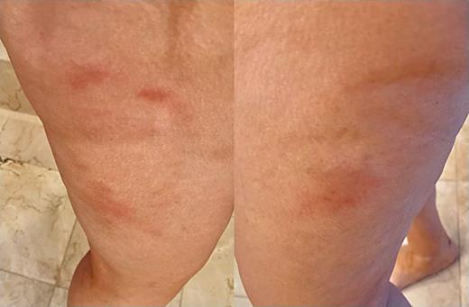 Rash on the right and left thighs.