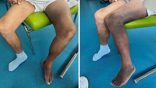 Increased leg circumference on the left side with large confluent reddish livid ecchymoses.