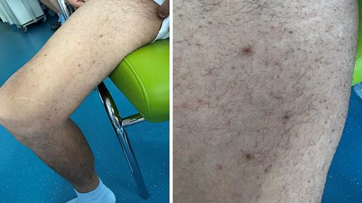 Multiple livid follicular macules and papules predominantly on the extremities.