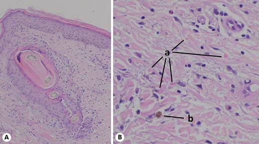 Skin biopsy revealed follicular hyperkeratosis with coiled, distorted hair shafts (A) and in the upper dermis (B) perivascular and perifollicular extravasated erythrocytes (a) and siderophages (b). Hematoxylin and eosin (HE)-staining, ×40 (A) and ×100 (B) magnification, respectively.