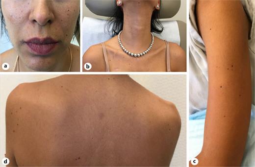New dark brown to black macules and papules of the face (a), neck (b), left arm (c), and back (d) that developed within 10 weeks after initiating encorafenib, cetuximab, and binimetinib combination therapy.
