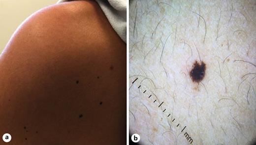 New dark brown to black papules on the posterior left shoulder (a), with fibrillar pigment network on dermoscopy (b).