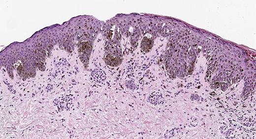 Punch biopsy of a 4-mm dark brown macule on the patient’s right upper arm was obtained. Immunohistochemistry for BRAF V600E showed negative staining in rare dermal melanocytic nests. H&E ×10 demonstrated a moderately atypical compound melanocytic nevus.