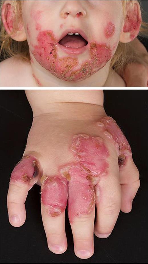 Initial presentation showing annular and polycyclic plaques and erosions of face and extremities, with typical “string of pearl” vesicles and bullae along the periphery.