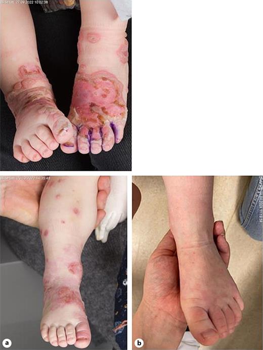 a Partial remission with still active lesions on the foot after treatment with dapsone. b Complete remission after combined treatment with sulfasalazine and dapsone.