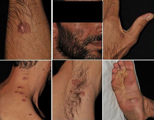 Clinical appearance of widespread papulonodular cutaneous lesions.