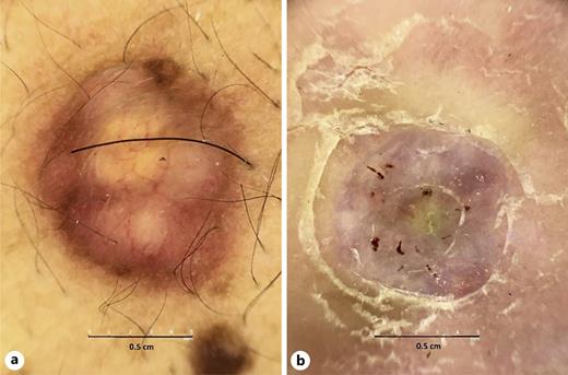 a Large yellow ovoid structures accompanied by linear vessels on a brown-pink background. b Cotton-like white globular structures over a pink background accompanied by hemorrhagic dots and peripheral scaling.