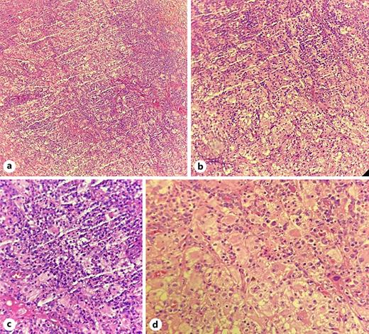 Areas of emperipolesis and a thick dermal infiltrate of large histiocytes mixed with lymphocytes were observed in the histopathologic assessment. H&E staining. a ×10, b ×40, c, d ×100.