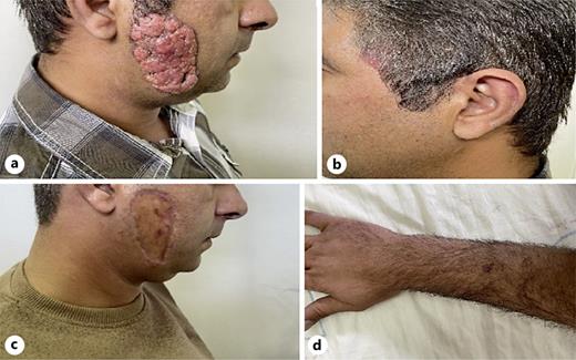 A 2 cm wide erythematous plaque is placed on the left cheek (b), and a red exophytic and Papillomatous mass with a diameter of 7 cm is present on the right cheek (a). Right cheek after surgery (c) and a recently developed lesion on the forearm (d).