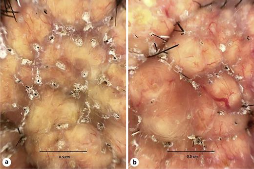 Large yellow ovoid structures accompanied by sharp focused linear vessels. Obvious follicular plugging, perifollicular scaling, and white linear opaque interfollicular structures (a, b).