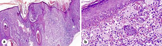Histiocytes and lymphoplasma cells were observed in the dermis with diffuse infiltration. The majority of histiocytes had a large amount of clear cytoplasm that was engulfed by lymphocytes (emperipolesis). H&E staining, a ×10, b ×100.