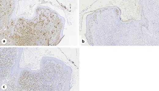 The histiocytes were negative for CD1a (b) but significantly positive for S-100 (a) and CD68 (c).