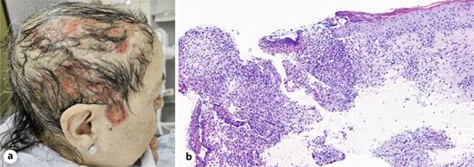 a Erosive disseminated lesions of the scalp with accompanying alopecia during amivantamab treatment. b Histology revealing an erosion with an underlying heavy inflammatory infiltrate of neutrophils (H/E, ×15).