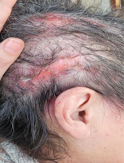 Spontaneous recurrence of the scalp lesions despite discontinuation of amivantamab therapy for 6 months.