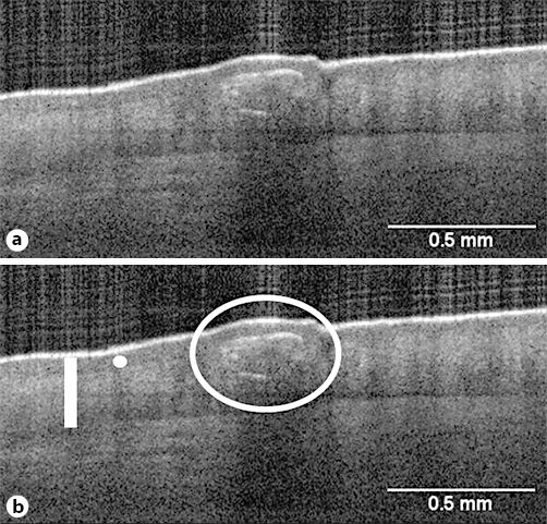 Fig. 1. a, b Vertical OCT image of the skin of an interdigital finger web. The mango-shaped mite (encircled) is surrounded by the hyperreflective burrow wall. The mite is just below the stratum granulosum (white dot). The epidermis is indicated by a white bar.