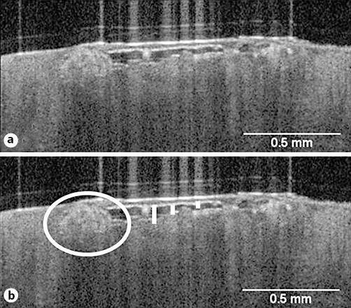 Fig. 2. a, b Vertical OCT image of a mite (encircled) at the end of a burrow. Possibly, there are eggs or fecal pellets in the burrow (burrow indicated by the vertical bars).