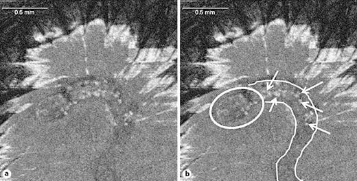 Fig. 3. a, b Horizontal OCT image of a mite (encircled) at the end of a burrow with eggs or fecal pellets (white arrows).