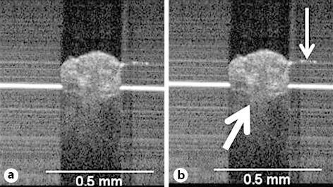 Fig. 4. a, b Vertical OCT image of a mite scanned ex vivo on a glass slide (thick arrow). The leg of the mite can be identified (thin arrow).