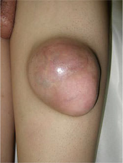 Fig. 1. Clinical photograph of the firm, movable, painless, subcutaneous mass, measuring approximately 10 × 8 × 7 cm in the patient's right thigh.