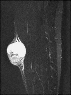 Fig. 2. T2-weighted MR imaging shows a solid subcutaneous mass containing a cystic lesion.