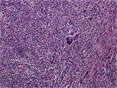 Fig. 4. In one region, the tumor was composed of a dense, tightly packed proliferation of spindle cells with elongated nuclei and prominent mitoses.