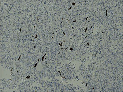 Fig. 5. Lesional tissue stained with desmin showing focally stained tumor cells.