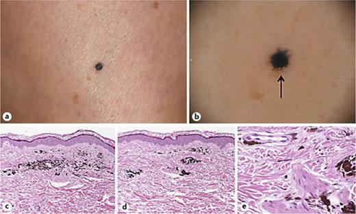 Blue Nevus with a Dermoscopic Appearance of Peripheral Streaks with ...