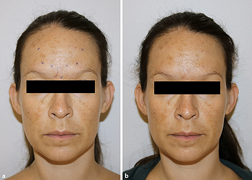 Fig. 1. a Injection sites marked before the procedure. b Two weeks after the procedure.