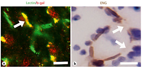 Fig. 3. Injection of Ad-Cre-mediated target gene deletion in the viral vector-injected region of the adult mouse brain. a Representative image of Ad-Cre-treated R26R mouse brain sections. The vessels were perfused with lectin, and lacZ expression was detected by immunostaining. Deletion of the floxed allele was observed in ECs (arrow). b Representative image of Ad-Cre-treated Eng2f/2f mouse brain sections shows enlarged dysplastic vessels. ENG expression was detected by immunostaining. Hematoxylin was used for counterstaining. A mosaic pattern of ENG expression was detected in the ECs lining this vessel; a majority of ECs expressed ENG, two ECs were ENG negative (arrow). Scale bars are 20 µm.