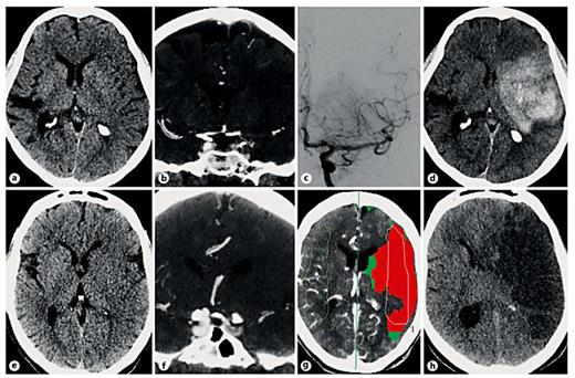 Value of Perfusion CT-Guided Recanalization Therapy in Acute Ischemic ...