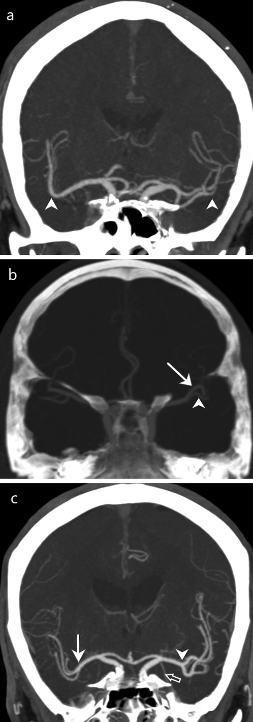  a This image demonstrates the classical/anatomical classification system. The M1 segment of the MCA turns into the M2 segment at the genu. The left M1 segment/MCA trunk bifurcates before the anatomical genu compared to the left side (both anatomical genua indicated with arrowheads). The left MCA segment proximal to the genu and distal to the bifurcation is still considered as the M1 segment. b This image demonstrates the structural/calibre classification system. This system uses the dimensions of the arteries to decide on classifying it as an LVO or MVO. The MCA trunk/M1 segment falls into the large vessel category due to its diameter of 3.24 mm. The two left MCA segments distal to bifurcation are classified as large vessel (arrow) and medium vessel (arrowhead) due to the diameter being >2.0 mm and ≤2.0 mm respectively. c This image demonstrates the functional/imaging classification system. The left M2 segments take origin from the point of bifurcation (arrowhead) of the left M1 segment of the left MCA. The right M2 segments take origin at the point of trifurcation (arrow) of the right M1 segment of the right MCA. The left anterior temporal artery (clear arrow) is visualized taking origin from the posterior aspect of left MCA trunk but does not affect the M1 and M2 segment definition.