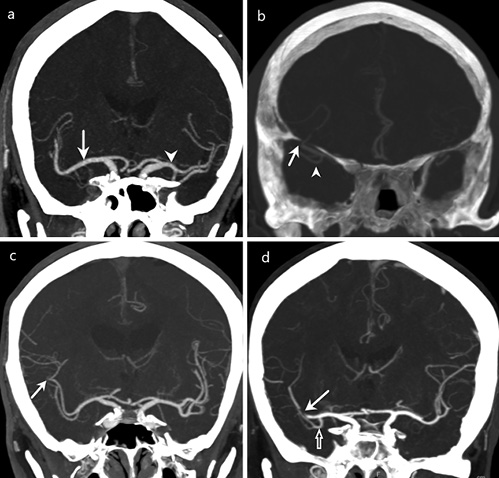  a Early bifurcation (<10 mm from origin of MCA) of the left MCA with the left M1 segment measuring 7.92 mm (arrowhead). The right MCA bifurcates at the genu with the M1 segment measuring 25.68 mm (arrow). b Right proximal M2 segment occlusion (arrow) with the right anterior temporal artery (arrowhead) seen branching from the M1 segment of the right MCA. c Distal right M2 segment occlusion (arrow) with partial reconstitution of flow distal to the occlusion site. d Right M2 segment occlusion (arrow) with a right hTA (clear arrow) which further bifurcates. d Illustrates how each classification system would provide a different nomenclature for the occlusion site: classical/anatomical: this occlusion would be classified as and M1 occlusion as it occurs before the anatomical genu. Structural/calibre: This occlusion would be classified as an LVO as the diameter measured just proximal to the occlusion was 2.10 mm. Angiographic/functional classification: This occlusion would be classified as an M2 segment occlusion as the occlusion is distal to the origin of the hTA.