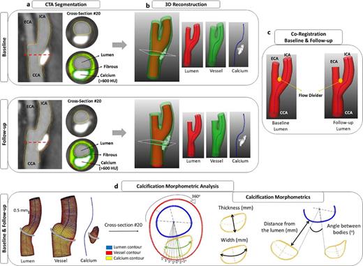 Pipeline of calcification morphometric analysis. a CTA segmentation of CCA, ICA, and external carotid artery (ECA) based on HU. b 3D reconstruction of lumen, vessel wall, and calcification. c Co-registration of baseline and follow-up geometries. d In-depth calcification morphometric analysis.