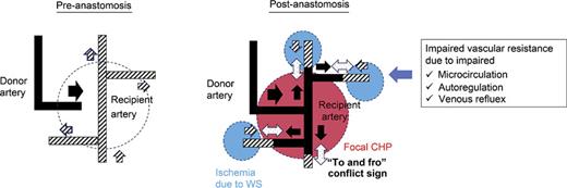 Schematic diagram of possible mechanisms of “to and fro” conflict sign. The “to and fro” conflict sign (dashed arrow) on the ICG-VA after revascularization surgery for MMD reflects the failure in adaptation to rapid hemodynamic changes after STA-MCA bypass. The “to and fro” conflict sign on intraoperative ICG-VA reflects the conflicting flow between the bypass flow supplied by the donor artery (black arrow) and the antegrade flow of recipient arteries (zebra arrow). If the antegrade flow of the naïve recipient artery conflicts with the bypass flow, it supplies the limited area around the anastomosis site, resulting in focal CHP around the anastomosis site. The area adjacent to the focal CHP can result in hypoperfusion because this area can be perfused solely by retrograde flow from adjacent cortical branches. This paradoxical ischemia in the area adjacent to the vascular territory supplied by the bypass was defined as hemodynamic ischemia due to the watershed shift (WS) phenomenon. Furthermore, dysregulation of autoregulatory mechanisms, and impaired microcirculation and venous draining systems may be attributable to the “to and fro” conflict sign in MMD patients who developed the focal CHP and/or WS phenomenon.