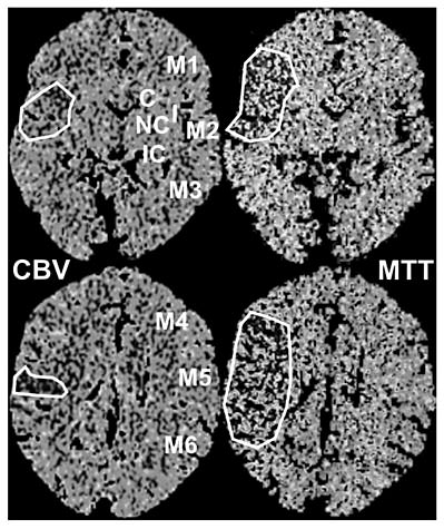 Fig. 1. CTP ASPECTS mismatch in a patient suffering from acute ischemia in the right MCA territory. In the CBV maps, ASPECTS areas I, M2, and M5 are affected (CBV ASPECTS = 7), whereas in the MTT maps areas I, M1, M2, M4, M5, and M6 display a perfusion defect (MTT ASPECTS = 4). Thus, CTP ASPECTS mismatch = 3.