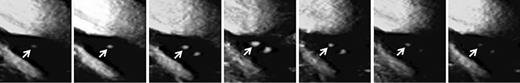 Fig. 1. SMI ultrasonograms of a 61-year-old man with symptomatic right ICA stenosis (95%) showing MES during exposure of the carotid arteries in endarterectomy. The arrows indicate IMVF signals as moving enhancements located near the surface of the plaque. The intensity of the signal becomes stronger from the left-end panel to the middle panel and weaker from the middle panel to the right-end panel.