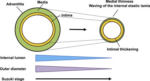Diagram for the development of MMD (modified from [19]). The phenomenon is that the involved arteries decrease their luminal diameter because of intimal thickening and their outer diameter because of medial degeneration and the waving of elastic lamina during disease progression in the early stage of MMD. Shrinkage of involved arteries progresses in parallel with the progression of luminal stenosis.