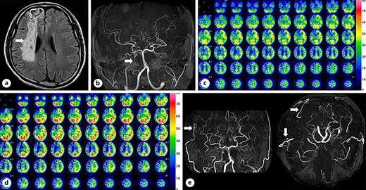 A case of MMD (presented as case 1 in [21]). a MRI shows a watershed infarction in the right cerebral hemisphere. b On MRA, the right ICA was poorly visualized (white arrow), and the left ICA was not visible. c SPECT at rest shows extremely reduced blood flow in the right cerebral hemisphere (left side). d Steal phenomenon was induced by Diamox administration in the right cerebral hemisphere (left side). e A good patency was confirmed after STA-MCA double bypass surgery on MRA (white arrows). ICA, internal carotid artery; MCA, middle cerebral artery; MRA, magnetic resonance angiography; SPECT, single-photon computerized tomography; STA, superficial temporal artery.
