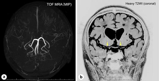 A middle-aged patient with ischemic-onset MMD, who was associated with Graves’ disease. a Magnetic resonance angiography indicates steno-occlusive changes at bilateral terminal internal carotid arteries with abnormal vascular network formation at the base of the brain. b Heavy T2-weighted imaging indicates outer diameter narrowing at bilateral terminal internal carotid arteries (yellow arrows).