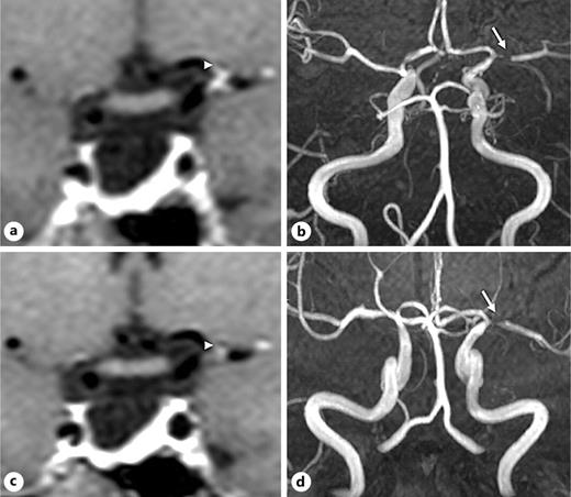 Coronal reformat of 3D T1 FS sequence of a patient at baseline demonstrating concentric grade 3 enhancement (white arrowheads) with 3D TOF MRA (a) showing narrowing (white arrows) of the left terminal ICA, proximal M1 MCA, and proximal A1 ACA (FCA score = 8) (b). Follow-up coronal 3D T1 FS demonstrating the reduction in degree of enhancement to grade 2 (white arrowheads) with similar extent (c) and 3D TOF MRA showing reduction in FCA score to 6 (d).