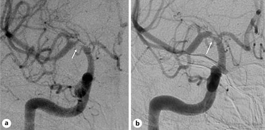 a Right ICA AP angiogram of a patient at baseline demonstrating the significant narrowing (white arrows) of right terminal ICA, proximal M1 MCA, and proximal A1 ACA (FCA score = 9). b Follow-up angiogram demonstrating the interval improvement in narrowing (FCA score = 7). AP, antiplatelets.
